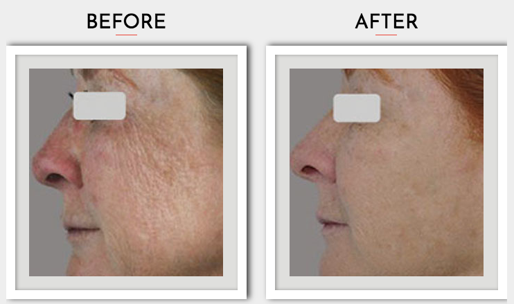 SharpLight Skin Rejuvenation Treatment Packages From