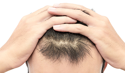 Hair Transplant